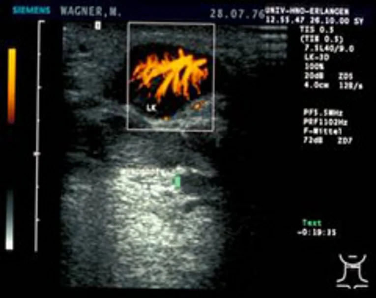 Ultraschallbild einer gut durchbluteten Raumforderung